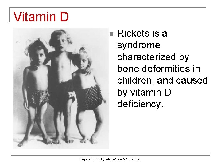 Vitamin D n Rickets is a syndrome characterized by bone deformities in children, and