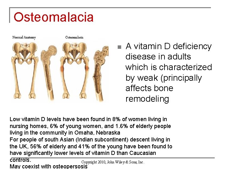 Osteomalacia n A vitamin D deficiency disease in adults which is characterized by weak