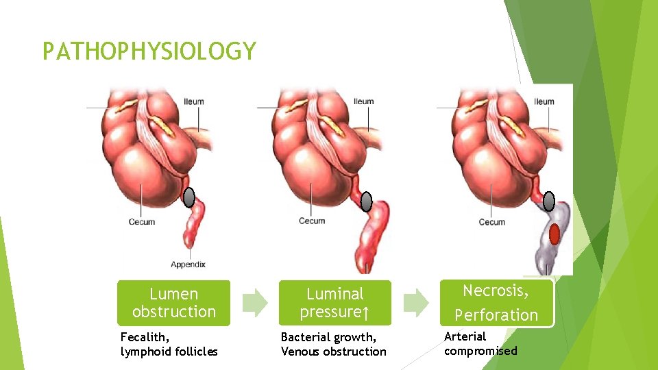 PATHOPHYSIOLOGY Lumen obstruction Fecalith, lymphoid follicles Luminal pressure↑ Bacterial growth, Venous obstruction Necrosis, Perforation