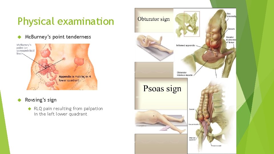 Physical examination Mc. Burney’s point tenderness Rovsing’s sign RLQ pain resulting from palpation in