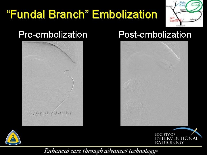 “Fundal Branch” Embolization Pre-embolization Post-embolization 