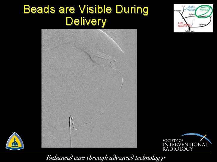 Beads are Visible During Delivery 