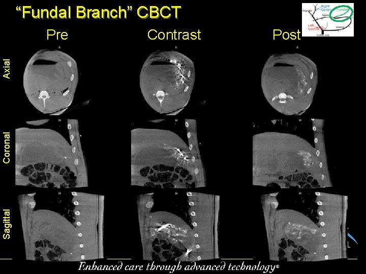 “Fundal Branch” CBCT Sagittal Coronal Axial Pre Contrast Post 