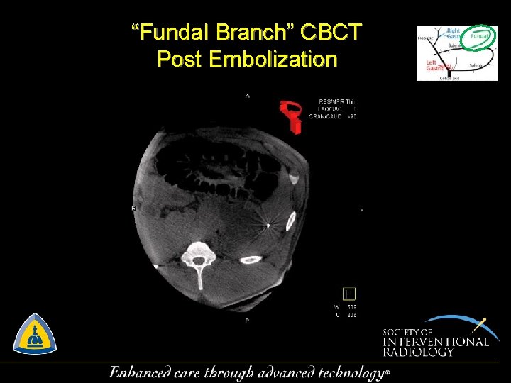 “Fundal Branch” CBCT Post Embolization 