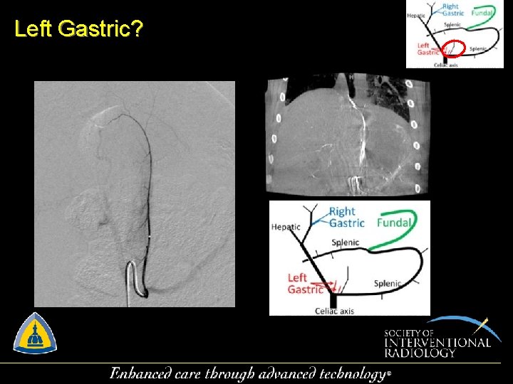 Left Gastric? 