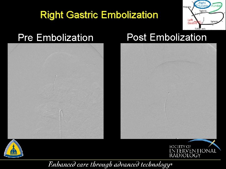 Right Gastric Embolization Pre Embolization Post Embolization 