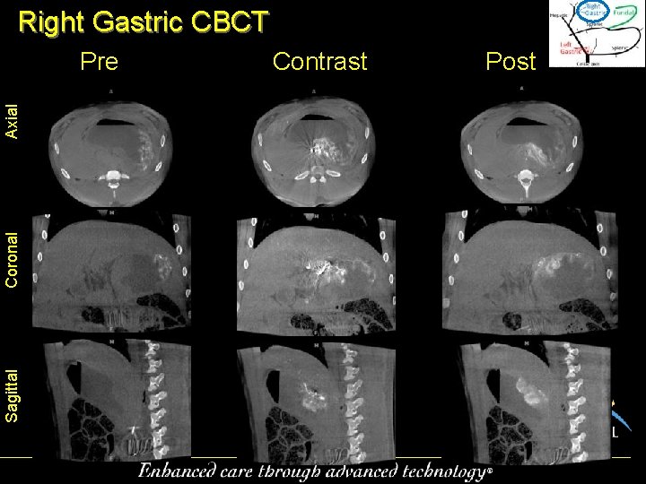 Right Gastric CBCT Sagittal Coronal Axial Pre Contrast Post 