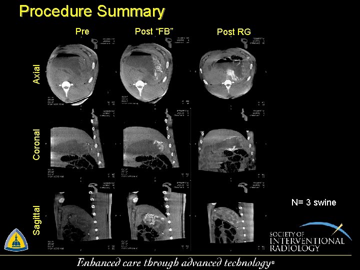Procedure Summary Post “FB” Post RG Sagittal Coronal Axial Pre N= 3 swine 