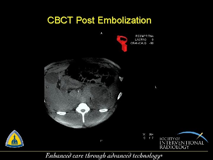 CBCT Post Embolization 