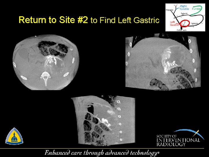 Return to Site #2 to Find Left Gastric 