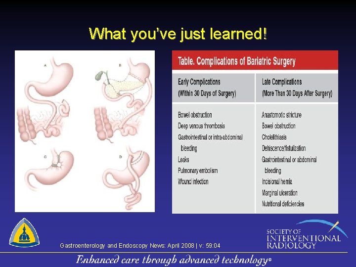 What you’ve just learned! Gastroenterology and Endoscopy News: April 2008 | v: 59: 04
