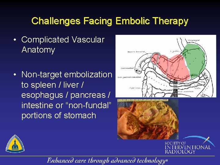 Challenges Facing Embolic Therapy • Complicated Vascular Anatomy • Non-target embolization to spleen /