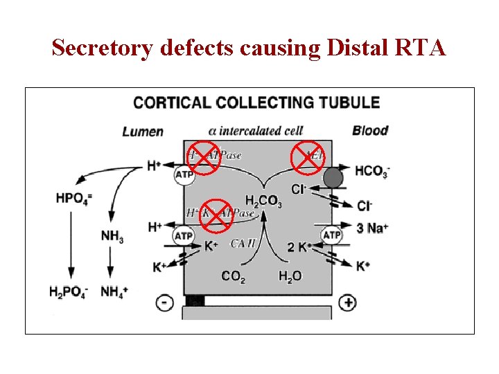 Secretory defects causing Distal RTA 
