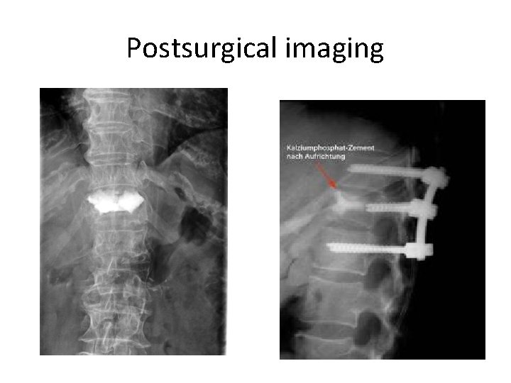 Postsurgical imaging 