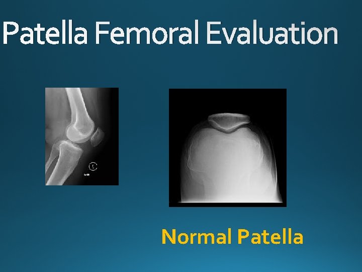 Patella Femoral Evaluation Normal Patella 