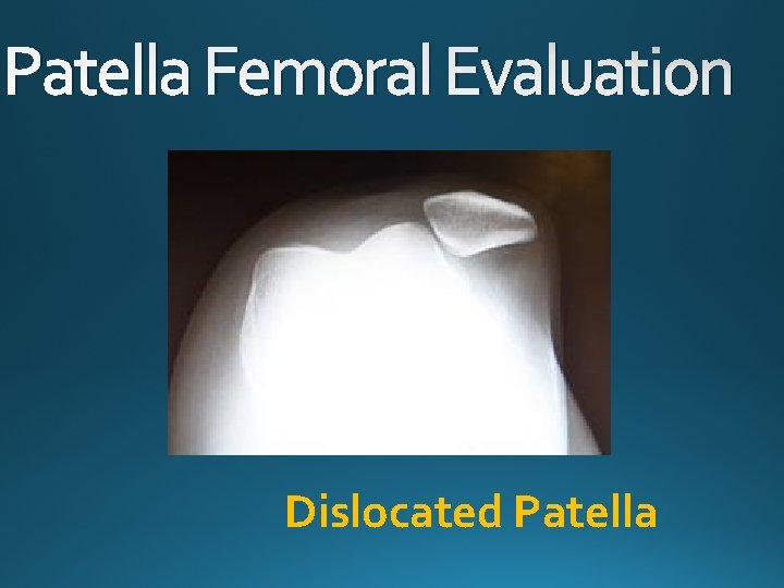 Patella Femoral Evaluation Dislocated Patella 