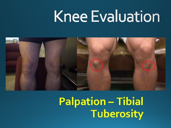 Knee Evaluation Palpation – Tibial Tuberosity 