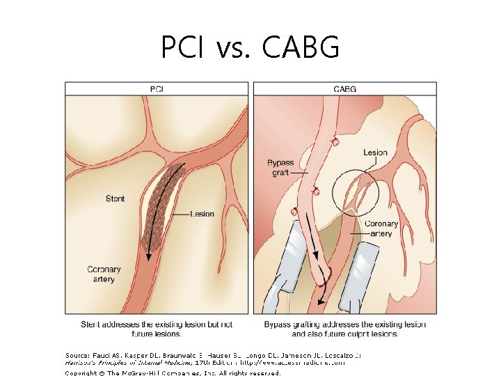 PCI vs. CABG 