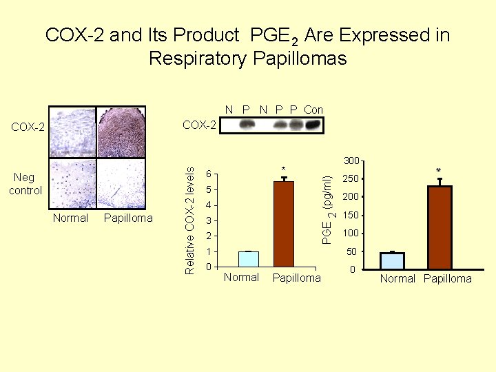 COX-2 and Its Product PGE 2 Are Expressed in Respiratory Papillomas N P P
