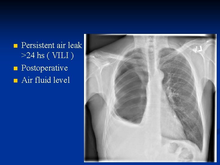 n n n Persistent air leak >24 hs ( VILI ) Postoperative Air fluid