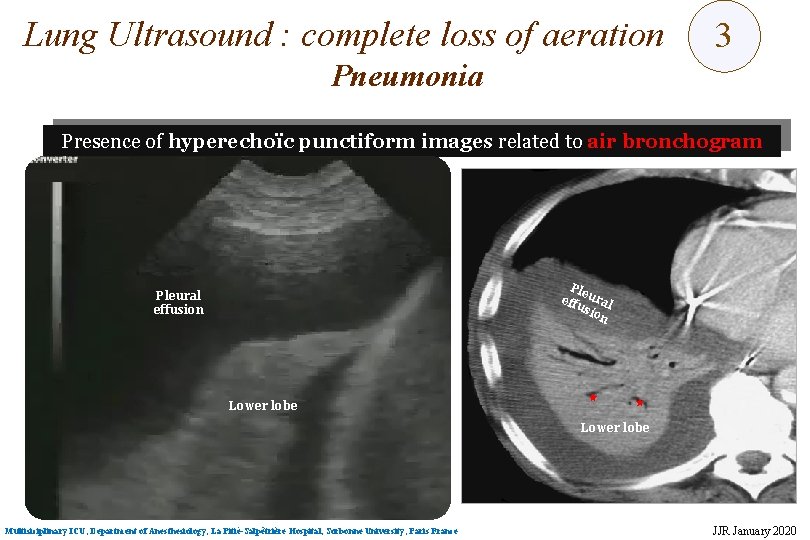 Lung Ultrasound : complete loss of aeration 3 Pneumonia Presence of hyperechoïc punctiform images Lung Ultrasound : complete loss of aeration 3 Pneumonia Presence of hyperechoïc punctiform images