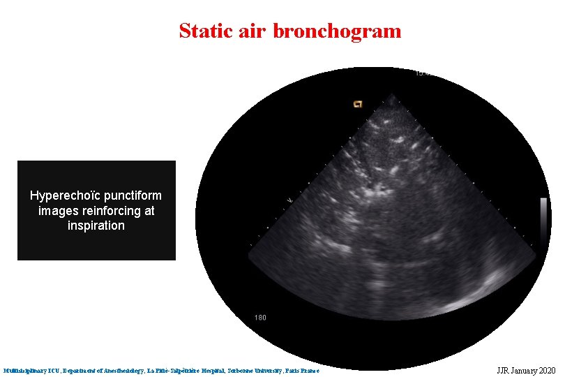Static air bronchogram Hyperechoïc punctiform images reinforcing at inspiration Multisiciplinary ICU, Department of Anesthesiology, Static air bronchogram Hyperechoïc punctiform images reinforcing at inspiration Multisiciplinary ICU, Department of Anesthesiology,