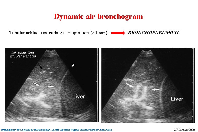 Dynamic air bronchogram Tubular artifacts extending at inspiration (> 1 mm) BRONCHOPNEUMONIA Lichtenstein Chest Dynamic air bronchogram Tubular artifacts extending at inspiration (> 1 mm) BRONCHOPNEUMONIA Lichtenstein Chest