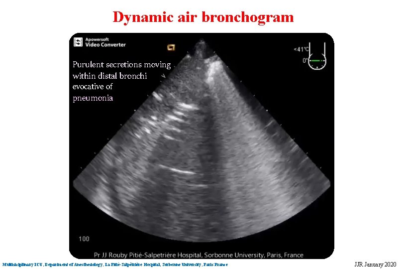 Dynamic air bronchogram Purulent secretions moving within distal bronchi evocative of pneumonia Multisiciplinary ICU, Dynamic air bronchogram Purulent secretions moving within distal bronchi evocative of pneumonia Multisiciplinary ICU,