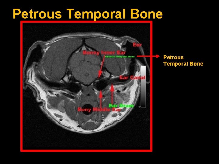 Petrous Temporal Bone 