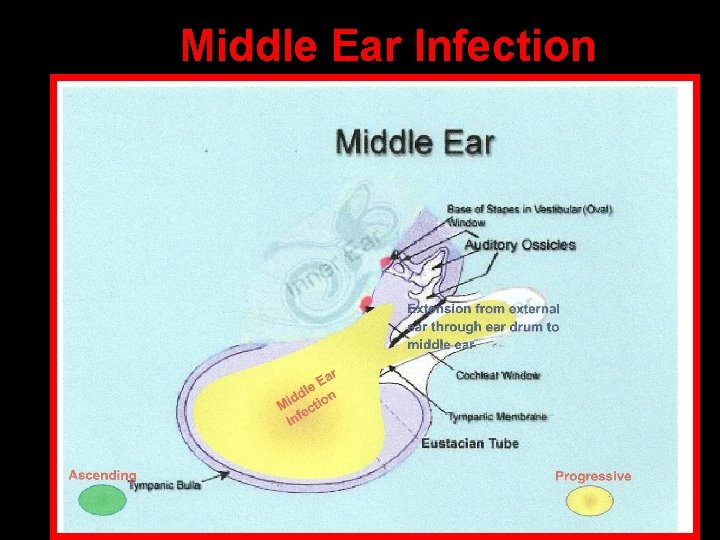 Middle Ear Infection 