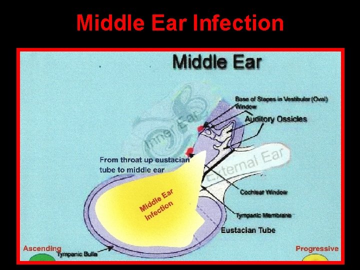 Middle Ear Infection 