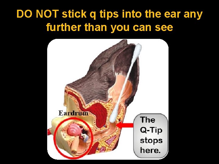 DO NOT stick q tips into the ear any further than you can see