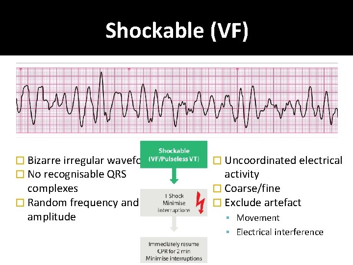 Shockable (VF) � Bizarre irregular waveform � No recognisable QRS complexes � Random frequency