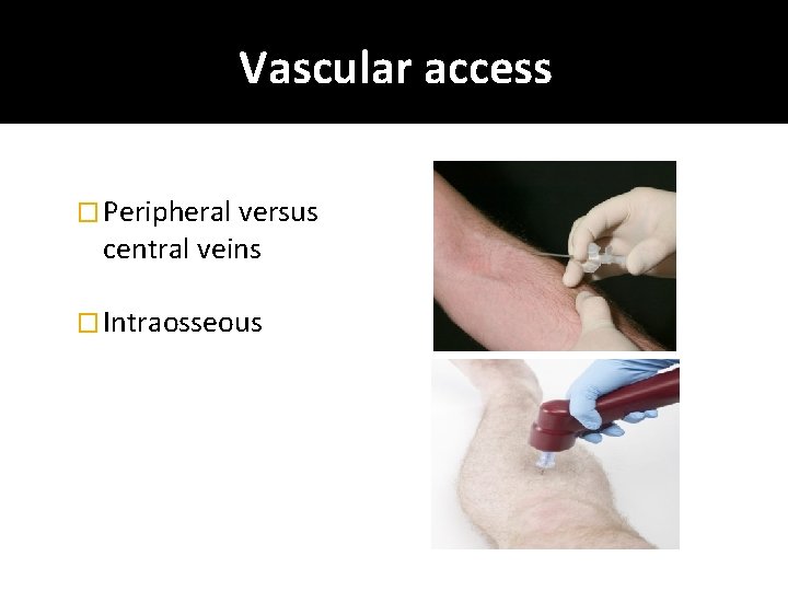 Vascular access � Peripheral versus central veins � Intraosseous 