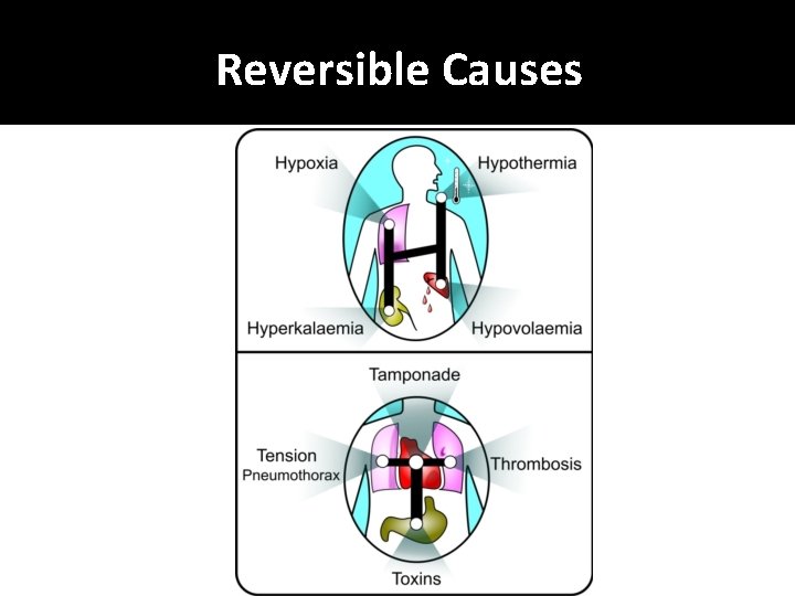Reversible Causes 