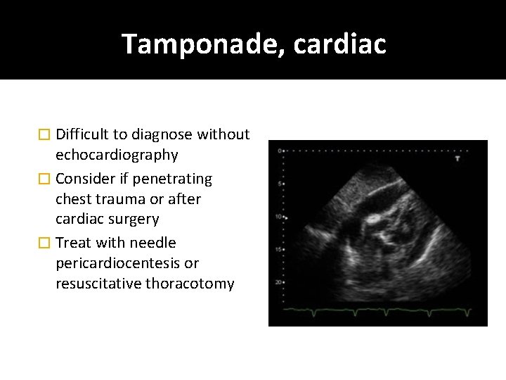 Tamponade, cardiac � Difficult to diagnose without echocardiography � Consider if penetrating chest trauma