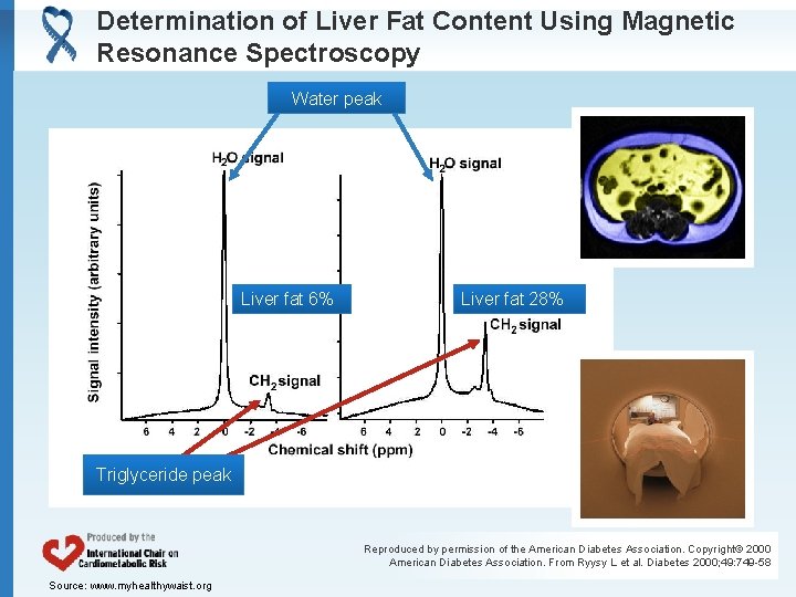 Determination of Liver Fat Content Using Magnetic Resonance Spectroscopy Water peak Liver fat 6%