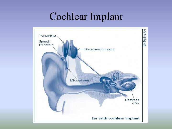 Cochlear Implant 