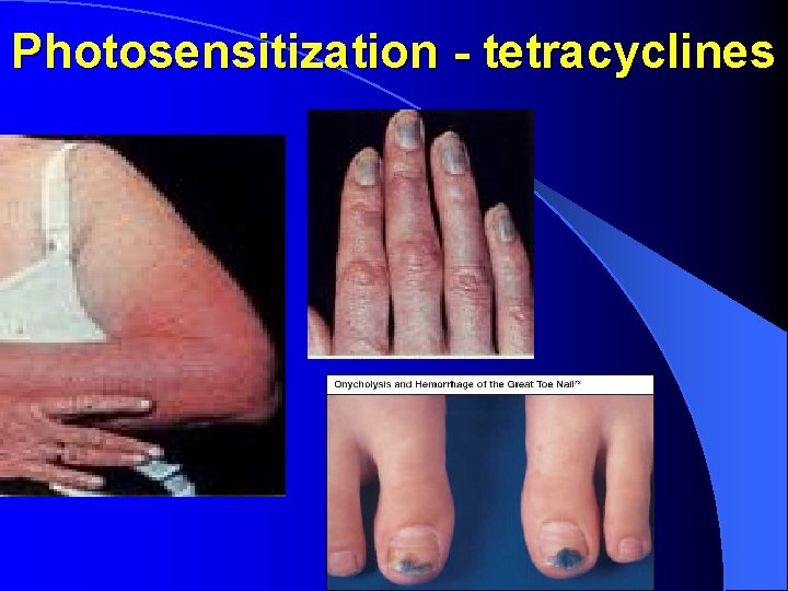 Photosensitization - tetracyclines 