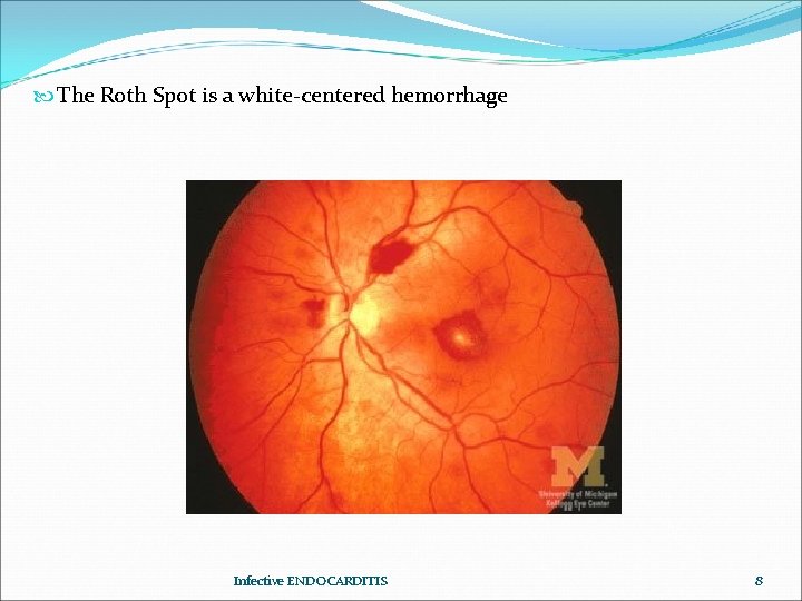  The Roth Spot is a white-centered hemorrhage Infective ENDOCARDITIS 8 