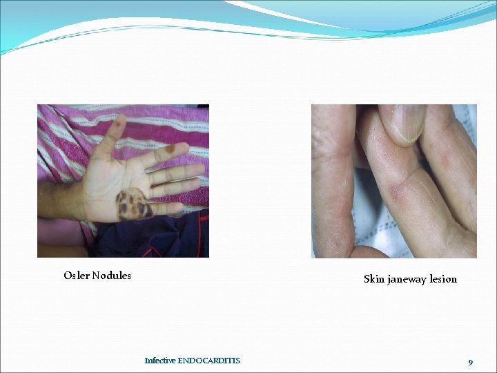 Osler Nodules Skin janeway lesion Infective ENDOCARDITIS 9 