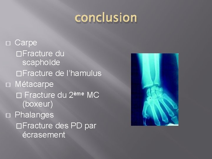 conclusion � � � Carpe �Fracture du scaphoïde �Fracture de l’hamulus Métacarpe � Fracture