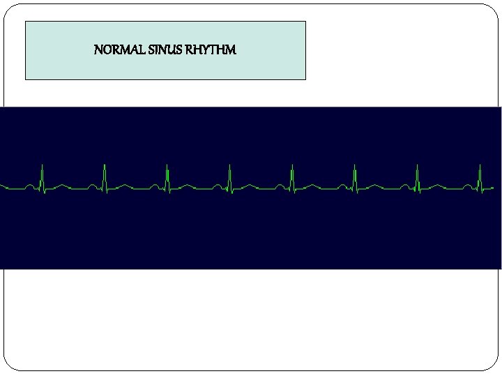NORMAL SINUS RHYTHM 