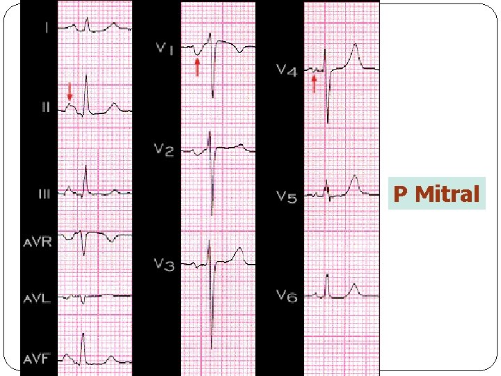 P Mitral 