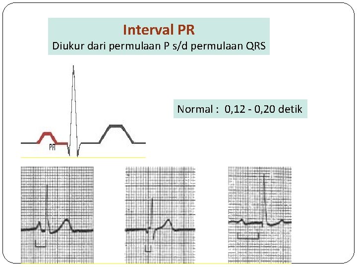 Interval PR Diukur dari permulaan P s/d permulaan QRS Normal : 0, 12 -