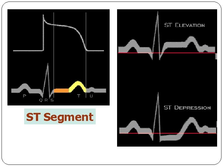 ST Segment 