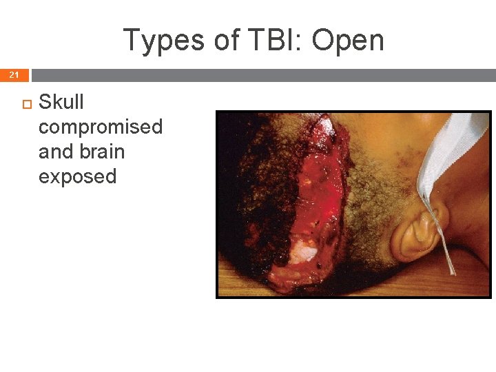 Types of TBI: Open 21 Skull compromised and brain exposed Head Trauma - 21
