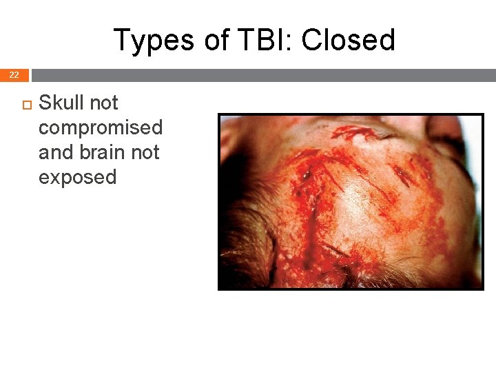 Types of TBI: Closed 22 Skull not compromised and brain not exposed Head Trauma