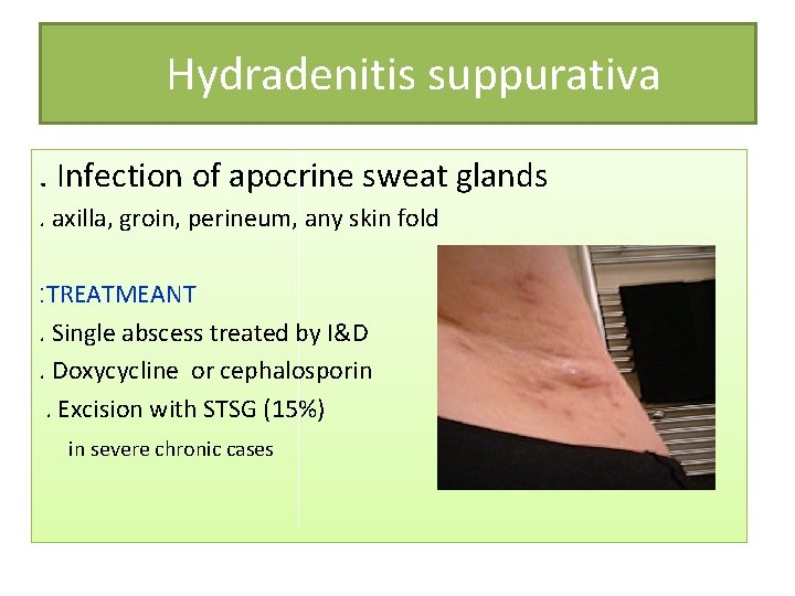 Hydradenitis suppurativa. Infection of apocrine sweat glands. axilla, groin, perineum, any skin fold :