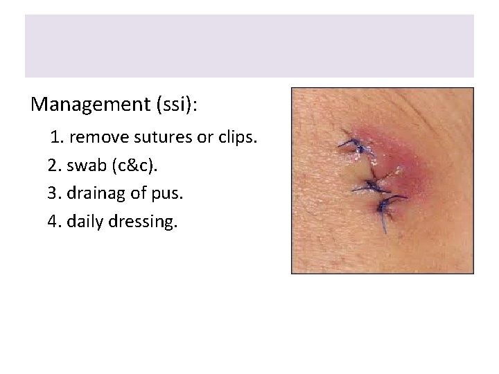 Management (ssi): 1. remove sutures or clips. 2. swab (c&c). 3. drainag of pus.
